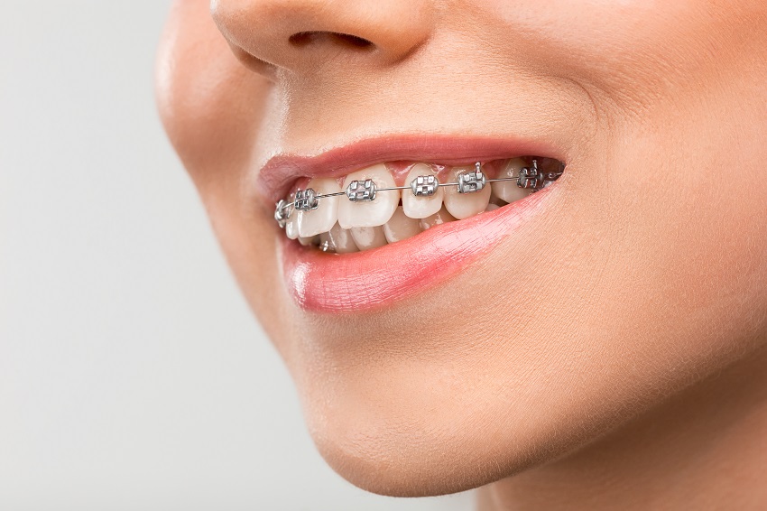 Mitos sobre la ortodoncia