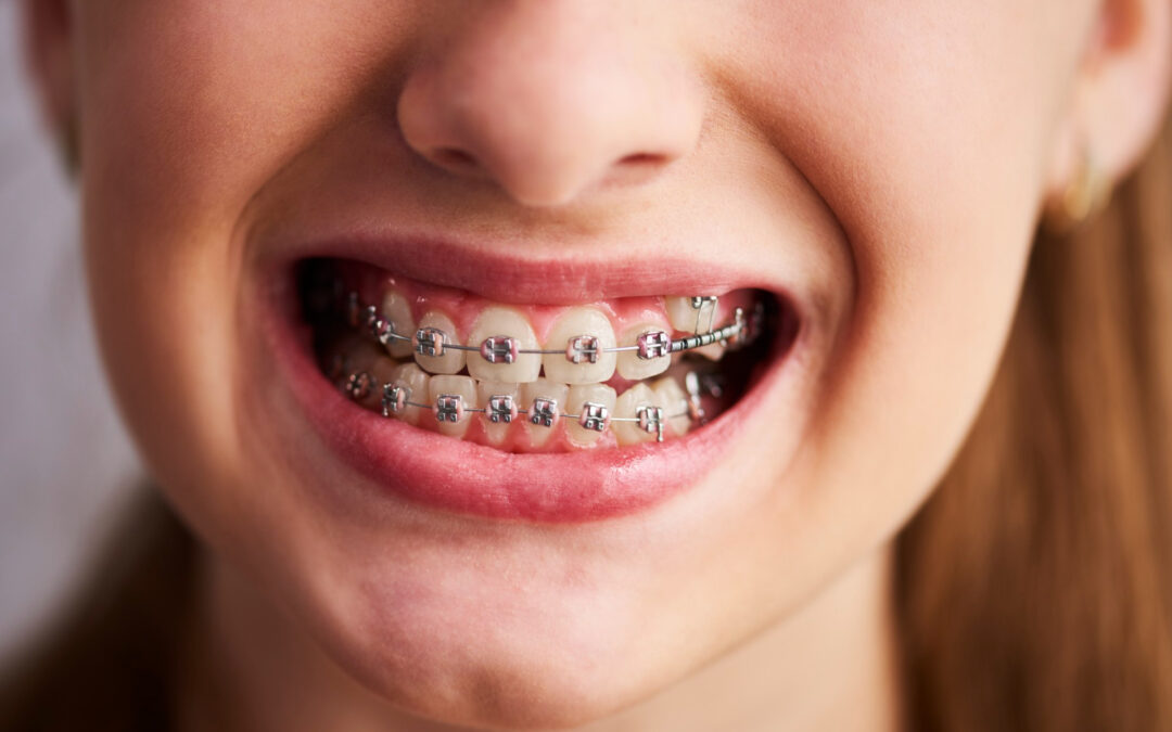 Beneficios de la ortodoncia
